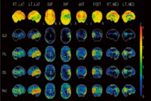 脳のPET/CT検査