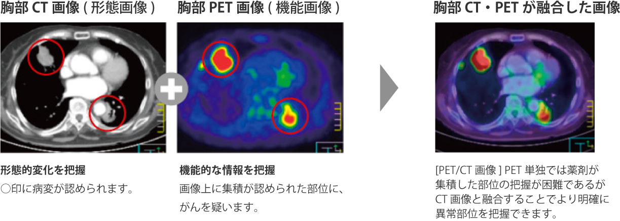 PET- CT+MRによる融合画像例